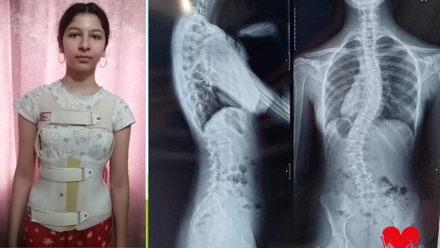 Maria, 15 ani: ”Fiecare zi îmi curbează coloana tot mai mult… Operația este șansa mea.”